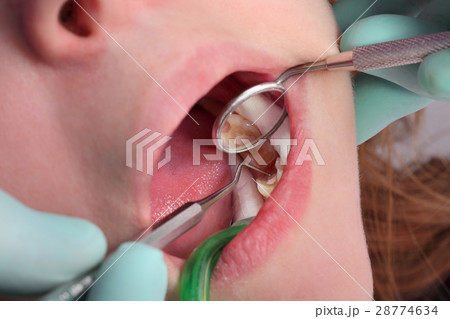 Dental procedure, tooth filling 28774634