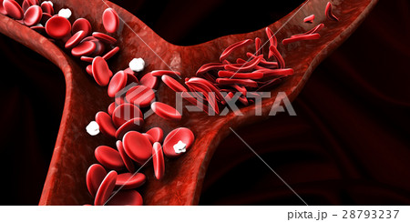Sickle cell anemia, showing blood vessel with 28793237