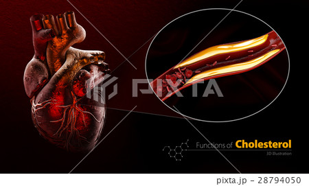 Blocked blood vessel, artery with cholesterol 28794050