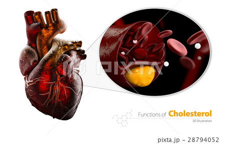 Heart as example, Blocked blood vessel, artery 28794052