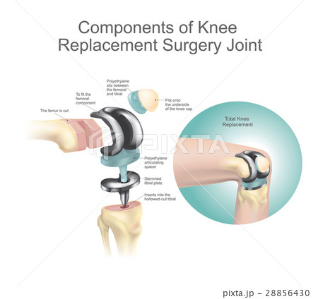 Components of knee replacement surgery joint. 28856430