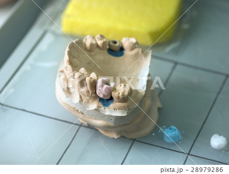 Dental Prosthesis Dental Prosthesis 28979286