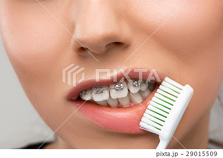 Beautiful young woman with teeth braces Beautiful young woman with teeth braces 29015509