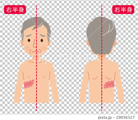 Symptoms of shingles 29056327