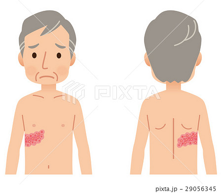 帯状疱疹　症状 29056345