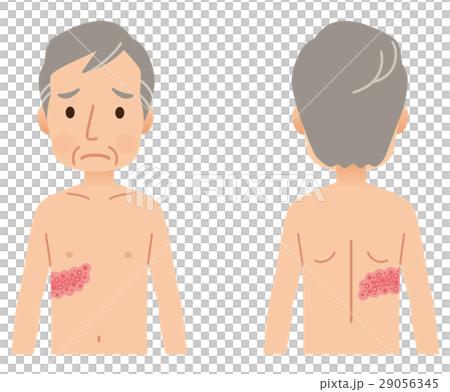 Symptoms of shingles 29056345