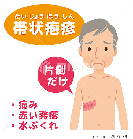帯状疱疹　症状 29056395