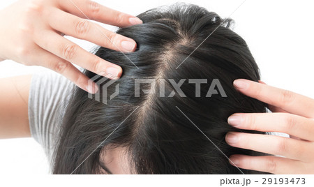 Woman serious hair loss problem 29193473
