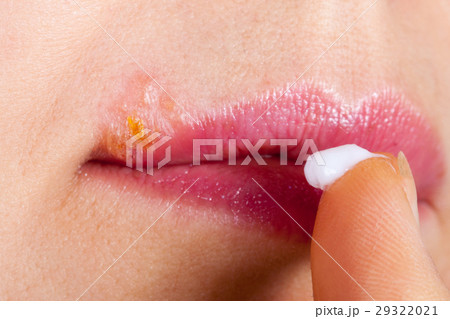 Herpes on the lip close-up macro. Woman lubricates 29322021