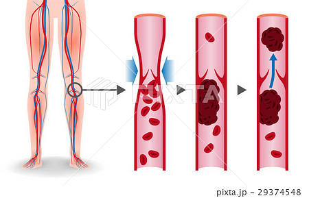 エコノミークラス症候群 深部静脈血栓症 メカニズムのイラスト素材