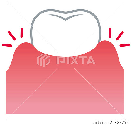 歯ぐきが腫れる 歯周病 歯ぐきが腫れる 歯周病 29388752