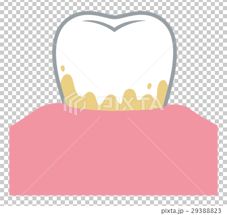 Dental calculus periodontitis 29388823