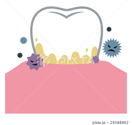 歯石　歯周病 29388862