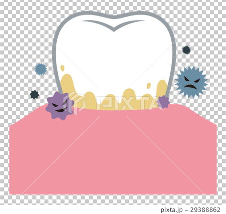 Dental calculus periodontitis 29388862