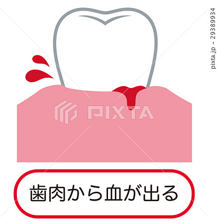歯ぐきから出血する　歯周病 29389934