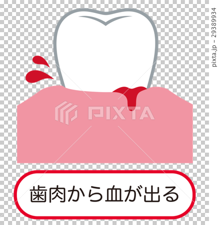 歯ぐきから出血する　歯周病 29389934