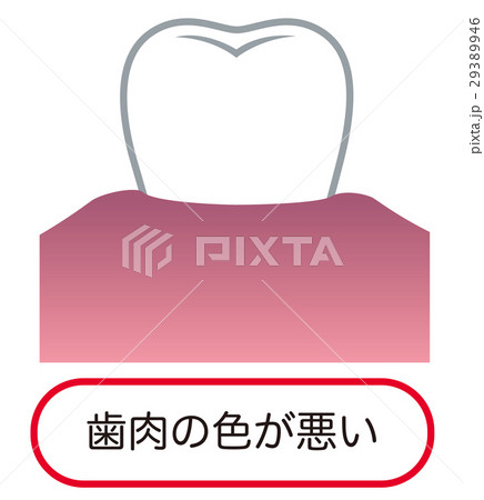 歯肉の色が悪い 歯周病 歯肉の色が悪い 歯周病 29389946