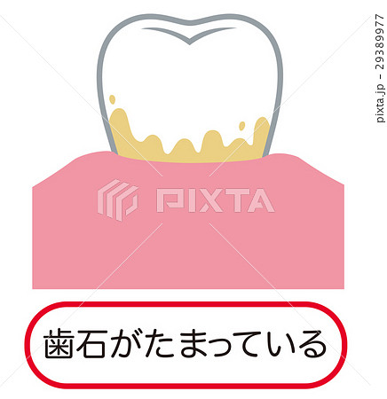 歯石 歯周病 歯石 歯周病 29389977