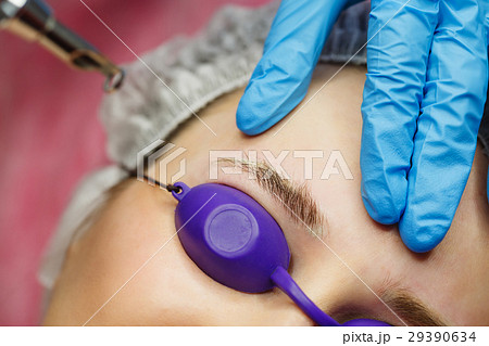 Laser removal of tattoo eyebrows 29390634