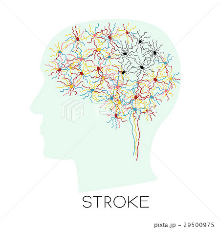 Stroke concept with human head silhouette 29500975