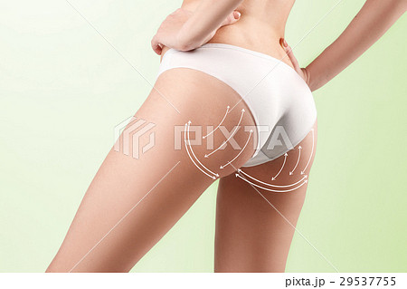 The cellulite removal plan. White markings on The cellulite removal plan. White markings on 29537755