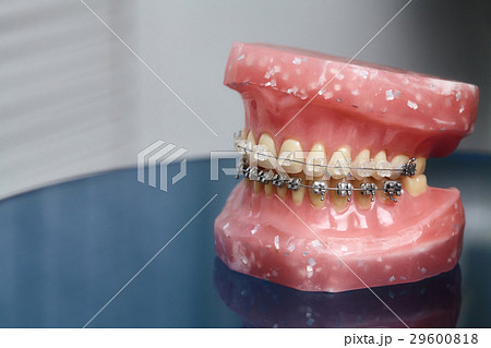 Human jaw or teeth model with wired dental braces Human jaw or teeth model with wired dental braces 29600818