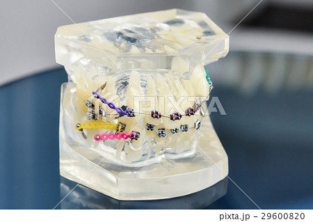 Orthodontic dental model with implants 29600820