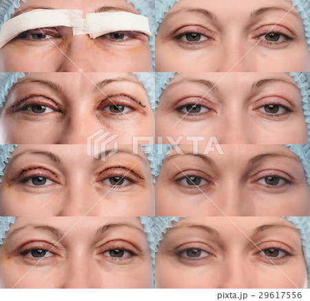 Blepharoplasty of the upper eyelid. 29617556