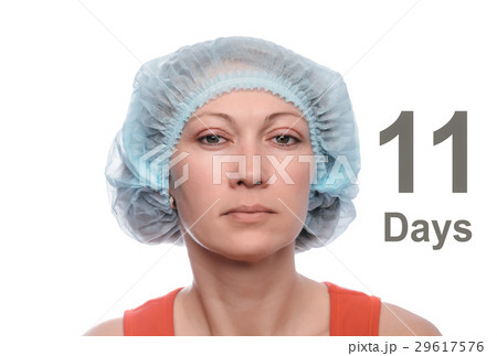 Blepharoplasty of the upper eyelid. 29617576