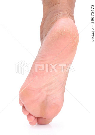 Cracks on Heels. Cracks on Heels. 29675478