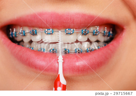 Woman smiling cleaning teeth with braces 29715667