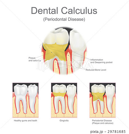 Dental calculus periodontal disease. Dental calculus periodontal disease. 29781685