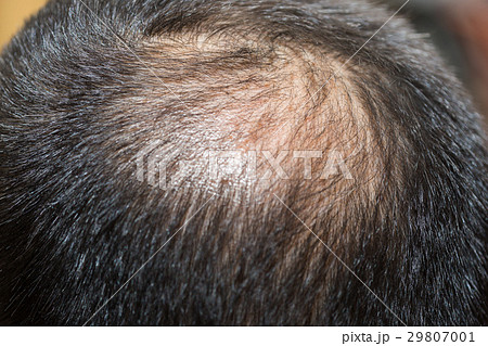 薄毛 薄毛 29807001