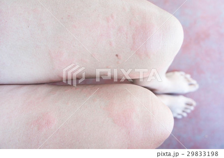 Rash from allergic infection, eczema dermatitis 29833198