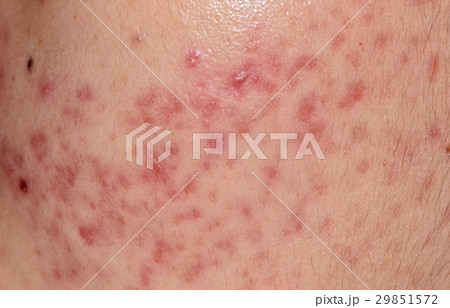 closeup skin problems, nodular cystic acne skin closeup skin problems, nodular cystic acne skin 29851572