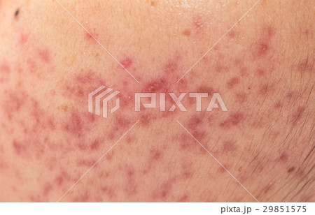 closeup skin problems, nodular cystic acne skin closeup skin problems, nodular cystic acne skin 29851575