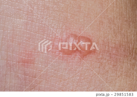 Closeup of skin with blisters.Burn wound skin 29851583