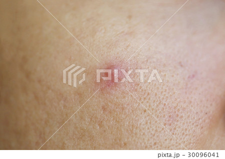 Acne on face of the women. Acne on face of the women. 30096041