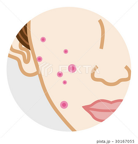 頬　ニキビ　ボディパーツ 30167055
