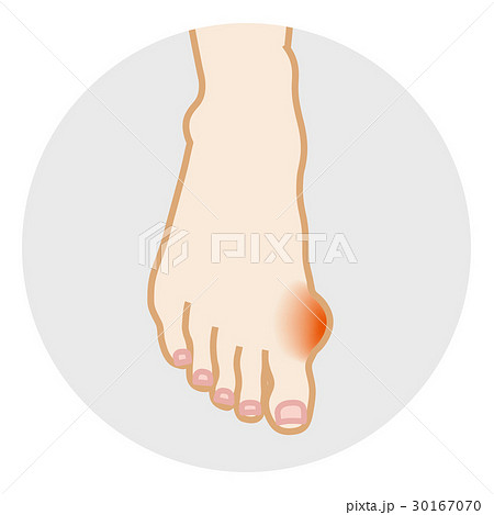 外反母趾 ボディパーツ 外反母趾 ボディパーツ 30167070