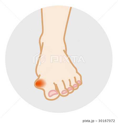 外反母趾　ボディパーツ　正面 30167072