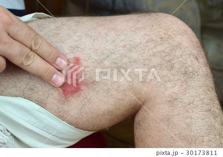 Applying Gel on Skin Applying Gel on Skin 30173811