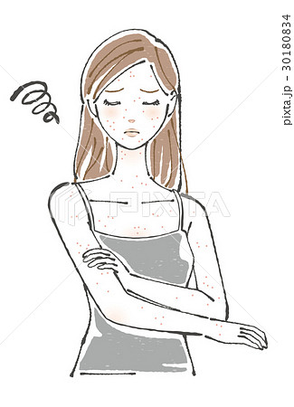 湿疹ができた女性 30180834