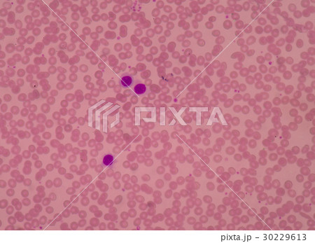 Blood smear show Red blood cells with  30229613