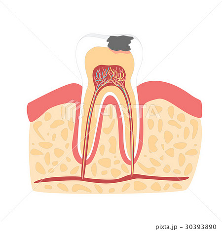 dental caries cartoon