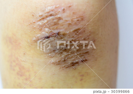 Closed up of red scab injury on woman knee Closed up of red scab injury on woman knee 30399866