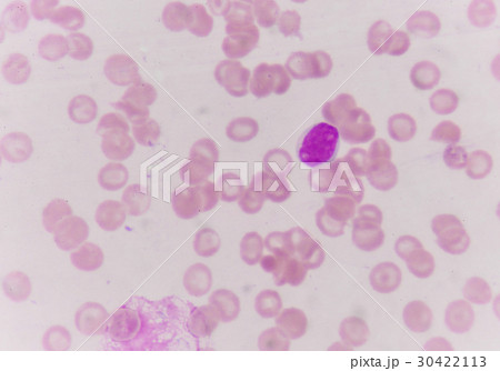 Blast cells in blood smear. 30422113