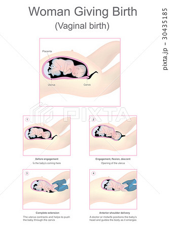 Woman giving birth (Vaginal birth).のイラスト素材 [30435185] - PIXTA