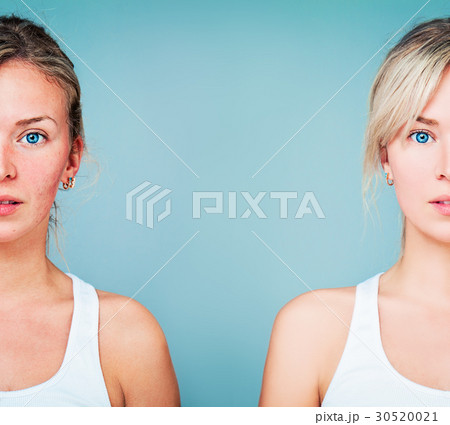 Young Woman with Perfect Skin and Skin Problem 30520021