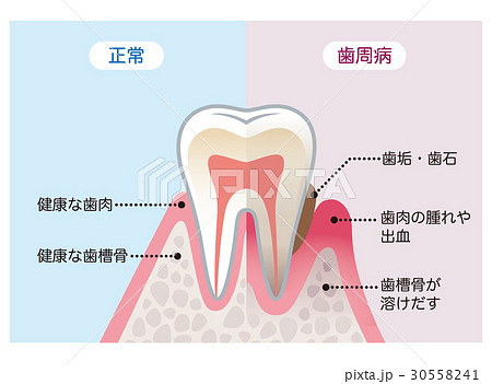 健康な歯と歯周病の歯 比較のイラスト素材